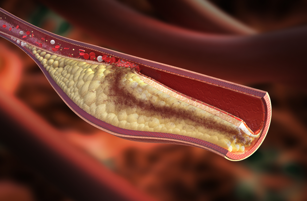 Lipid Disorders