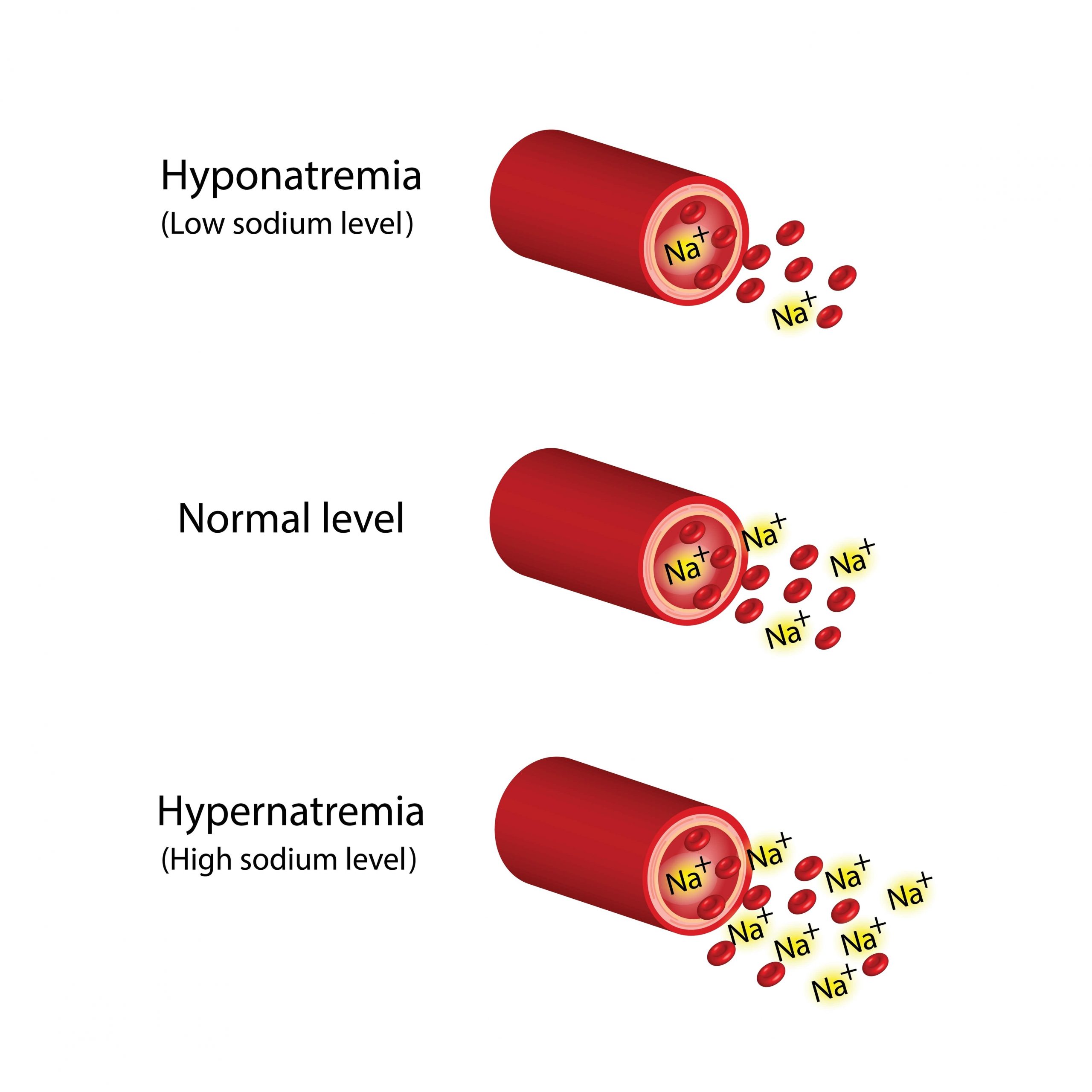 Approach to Hyponatremia