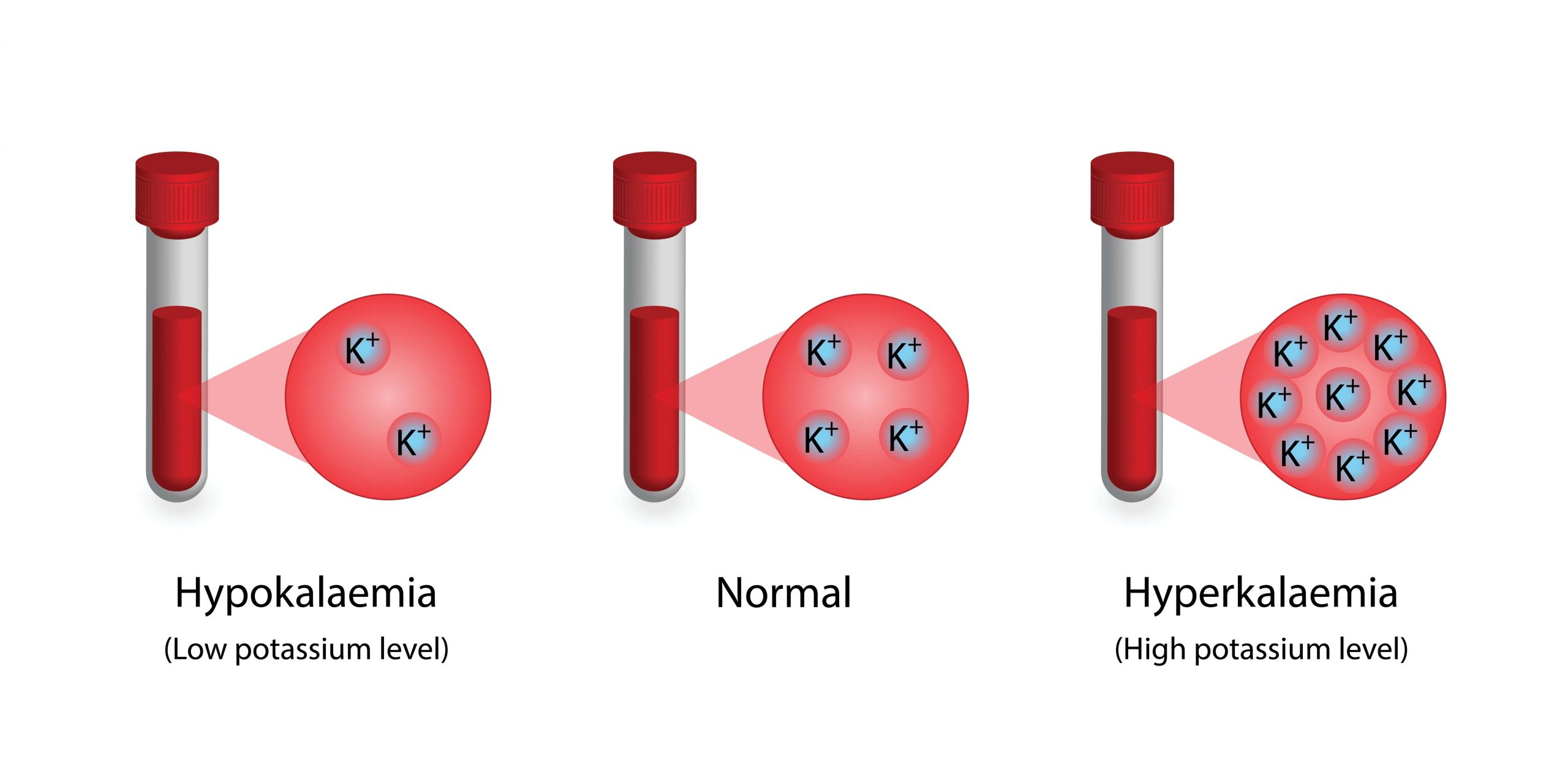 Approach to Hyperkalemia