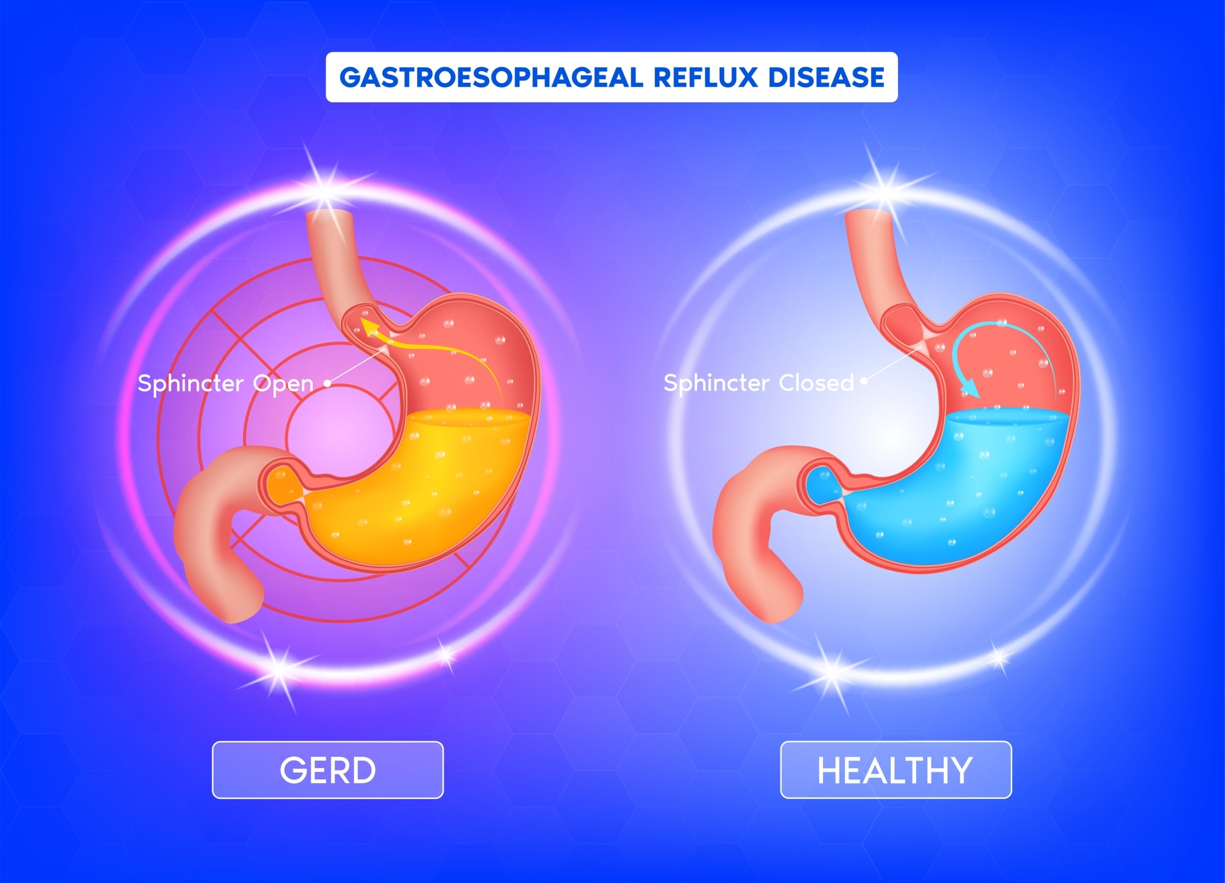 Gastroesophageal Reflux Disease (GERD)